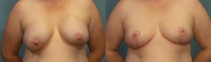 Breast Revision Before & After Gallery - Patient 458392 - Image 1