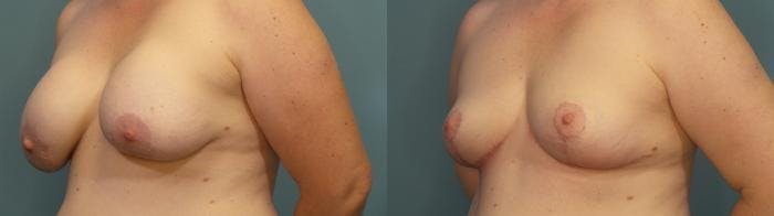 Breast Revision Before & After Gallery - Patient 458392 - Image 2