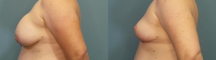 Breast Revision Before & After Gallery - Patient 458392 - Image 3