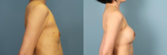 Breast Revision Before & After Gallery - Patient 165229 - Image 3