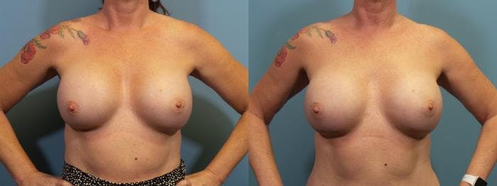 Breast Revision Before & After Gallery - Patient 238152 - Image 1