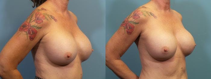 Breast Revision Before & After Gallery - Patient 238152 - Image 2
