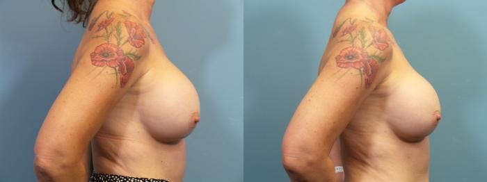Breast Revision Before & After Gallery - Patient 238152 - Image 3