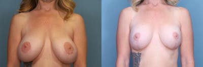 Breast Revision Before & After Gallery - Patient 708694 - Image 1