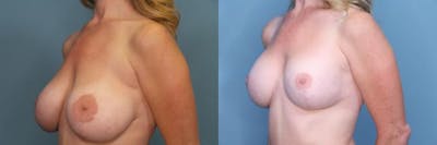 Breast Revision Before & After Gallery - Patient 708694 - Image 2