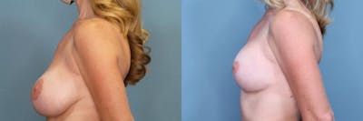 Breast Revision Before & After Gallery - Patient 708694 - Image 3