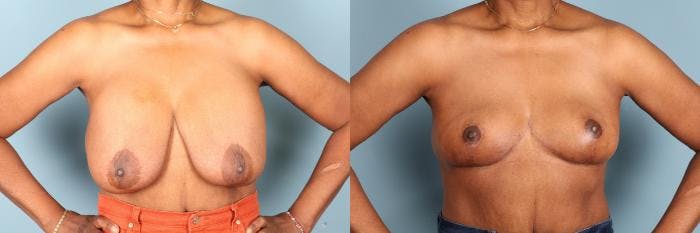 Breast Revision Before & After Gallery - Patient 145499 - Image 1