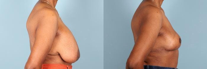 Breast Revision Before & After Gallery - Patient 145499 - Image 3
