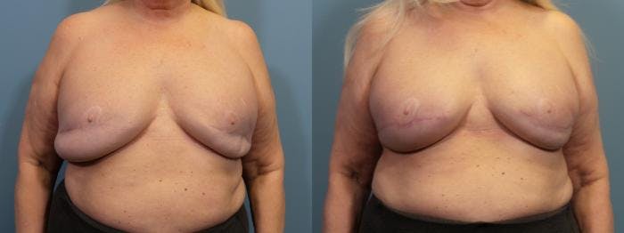 Breast Revision Before & After Gallery - Patient 590712 - Image 1