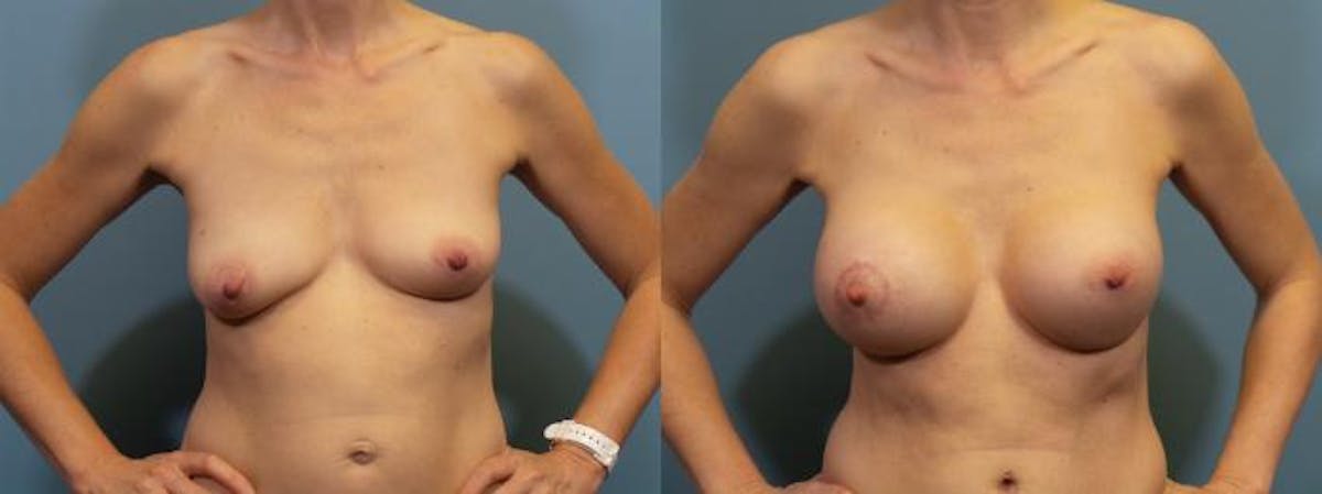 Breast Lift Before & After Gallery - Patient 158501 - Image 1