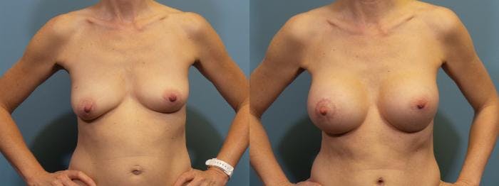 Breast Lift Before & After Gallery - Patient 158501 - Image 1