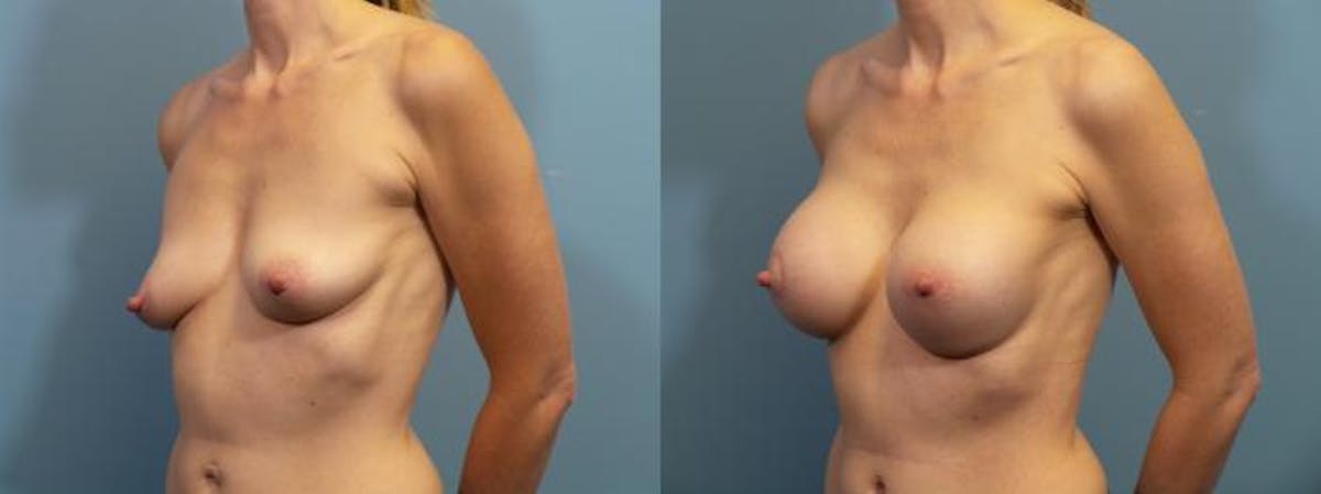 Breast Lift Before & After Gallery - Patient 158501 - Image 2