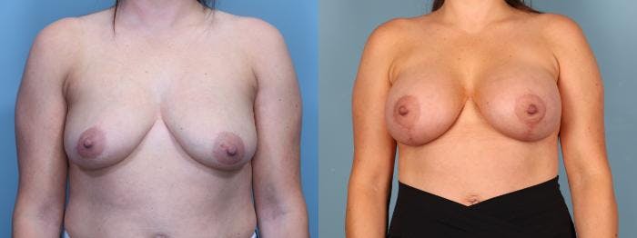 Breast Lift Before & After Gallery - Patient 910887 - Image 1
