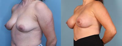 Breast Lift Before & After Gallery - Patient 910887 - Image 2