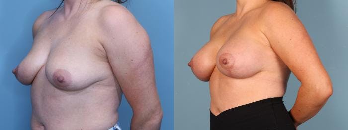 Breast Lift Before & After Gallery - Patient 910887 - Image 2