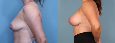 Breast Lift Before & After Gallery - Patient 910887 - Image 3