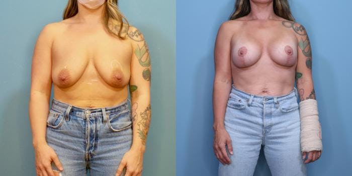 Breast Lift Before & After Gallery - Patient 421848 - Image 1