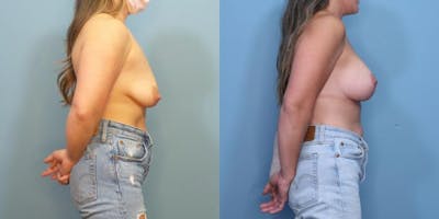 Breast Lift Before & After Gallery - Patient 421848 - Image 3