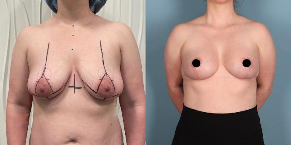 Breast Lift Before & After Gallery - Patient 385623 - Image 1