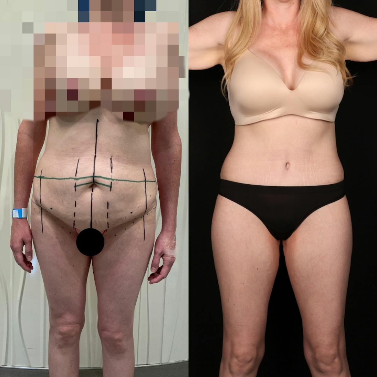 Massive Weight Loss/Body Lift Before & After Gallery - Patient 283666 - Image 1