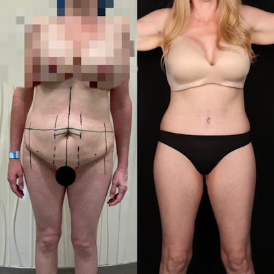 Massive Weight Loss/Body Lift Before & After Gallery - Patient 283666 - Image 1