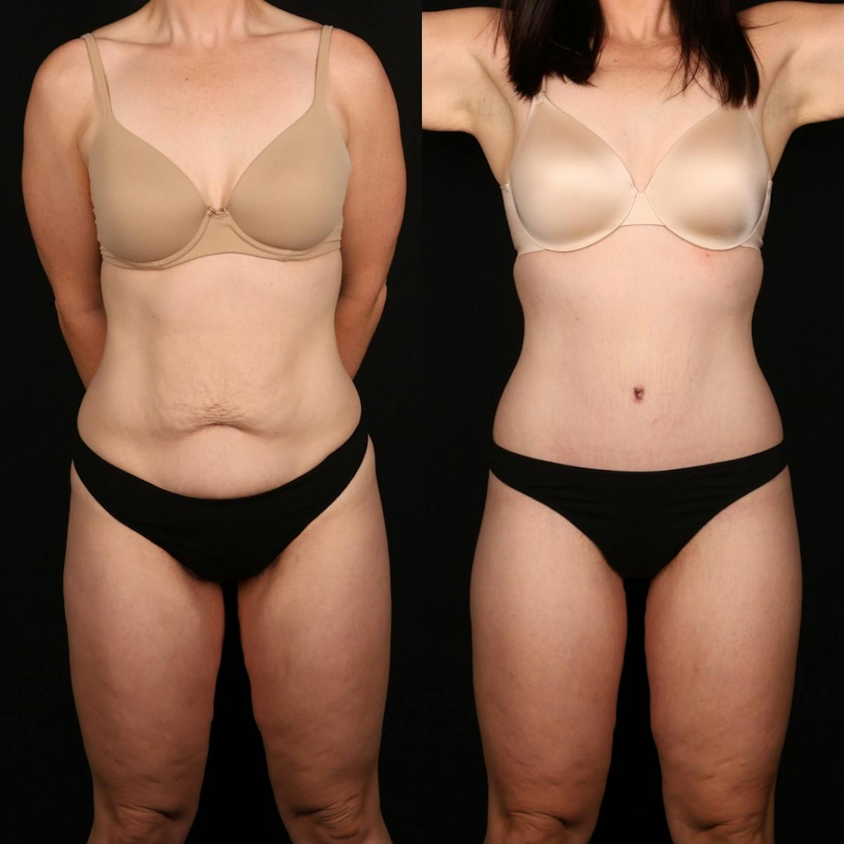Massive Weight Loss/Body Lift Before & After Gallery - Patient 204639 - Image 1