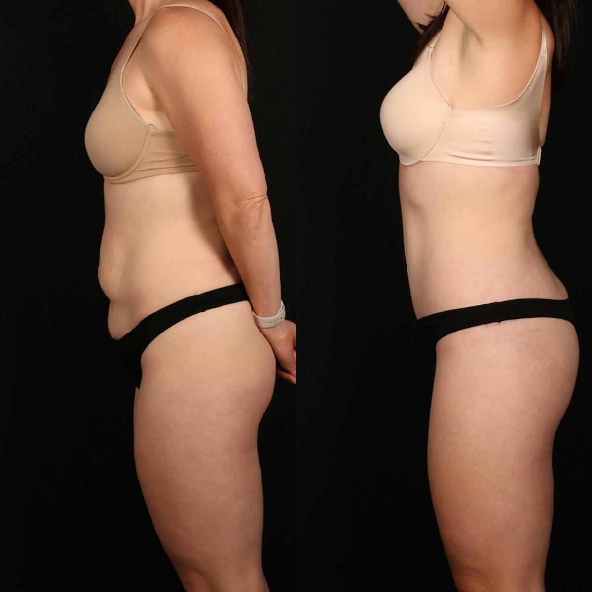Massive Weight Loss/Body Lift Before & After Gallery - Patient 204639 - Image 2