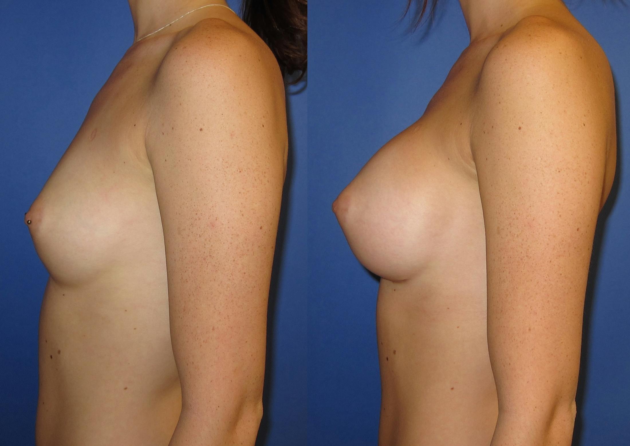 Breast Augmentation Before & After Gallery - Patient 171112 - Image 3