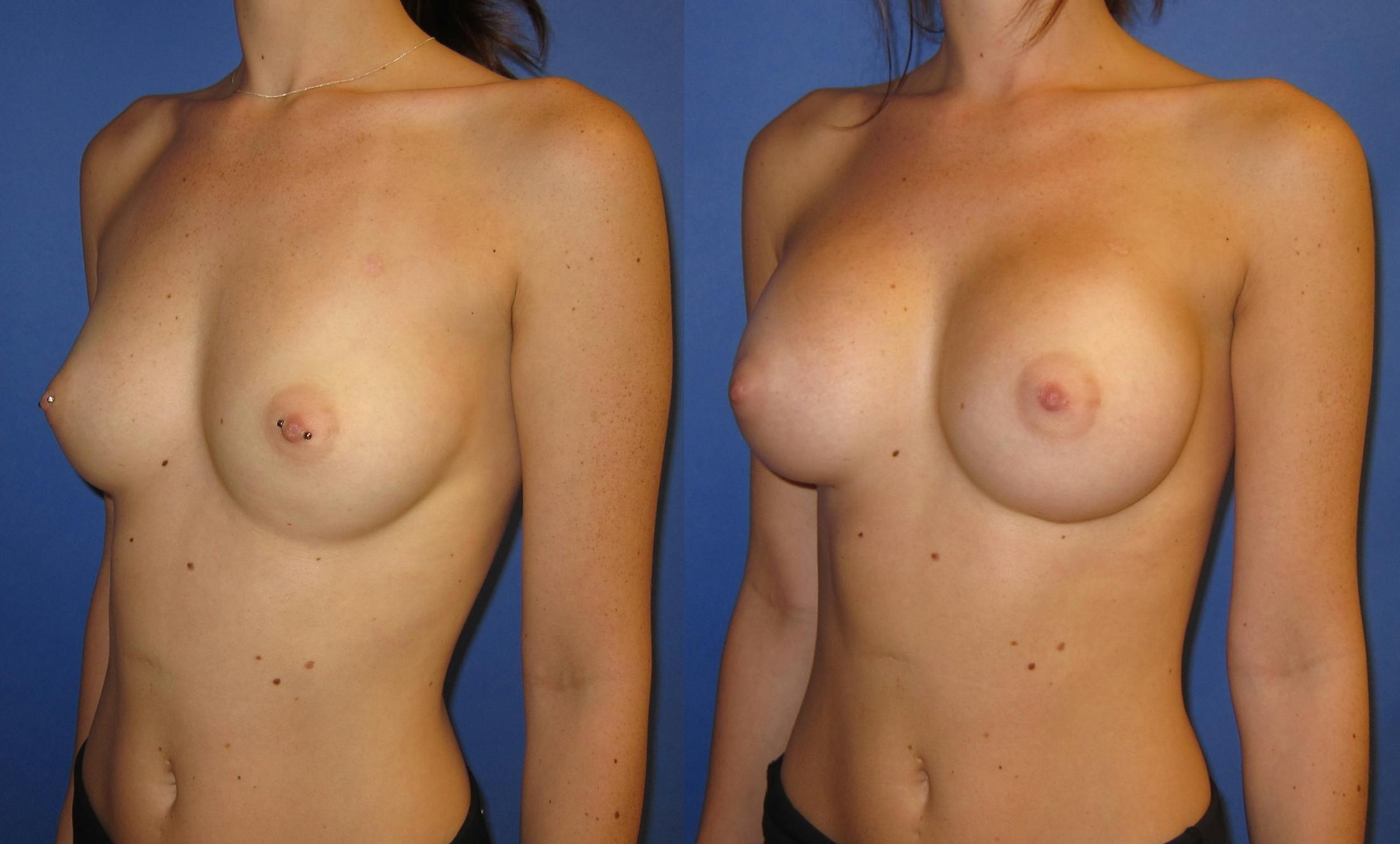 Breast Augmentation Before & After Gallery - Patient 171112 - Image 2