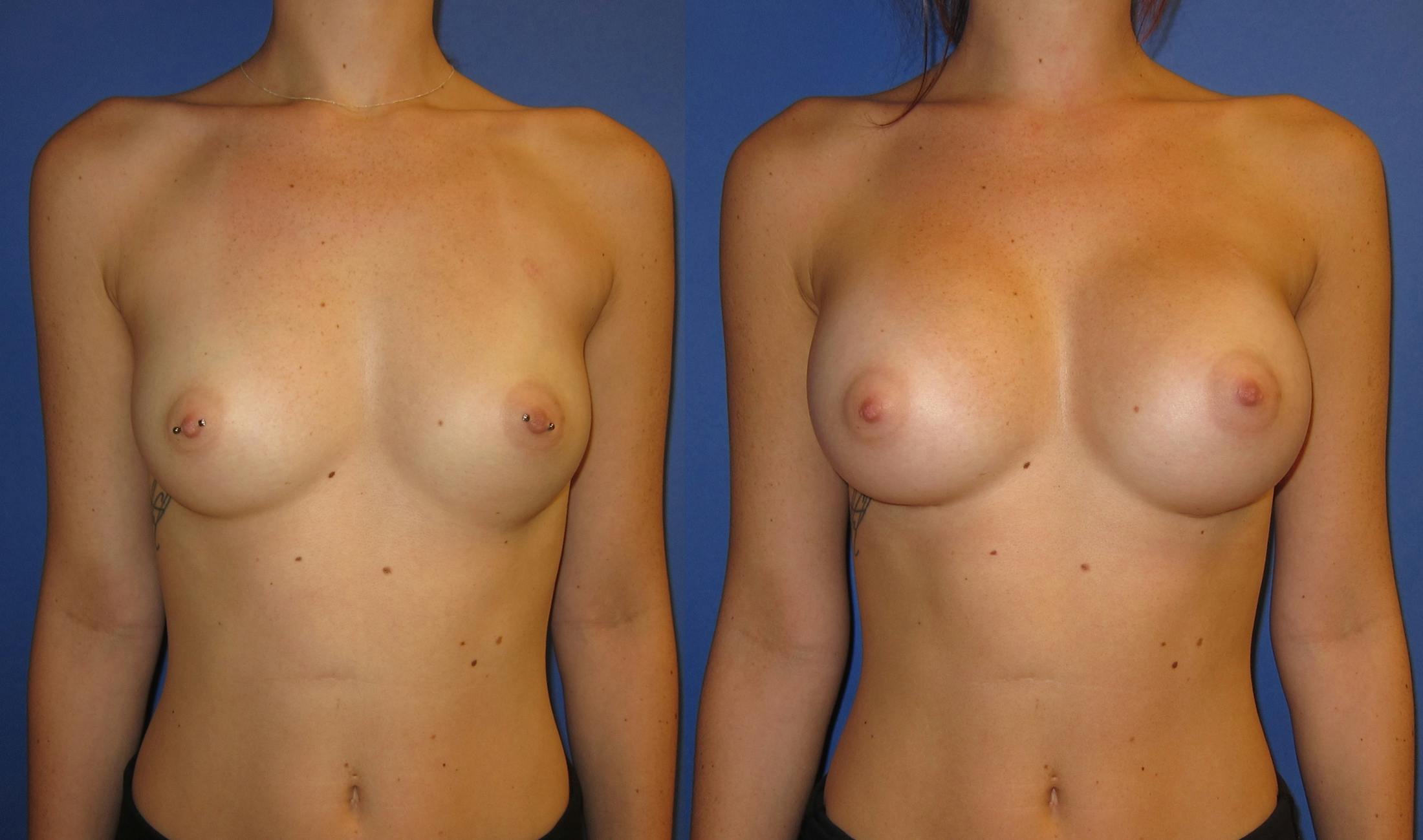 Breast Augmentation Before & After Gallery - Patient 171112 - Image 1