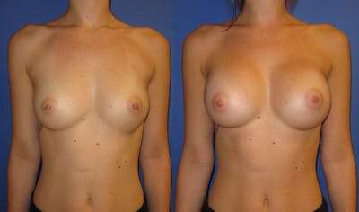 Breast Augmentation Before & After Gallery - Patient 171112 - Image 1