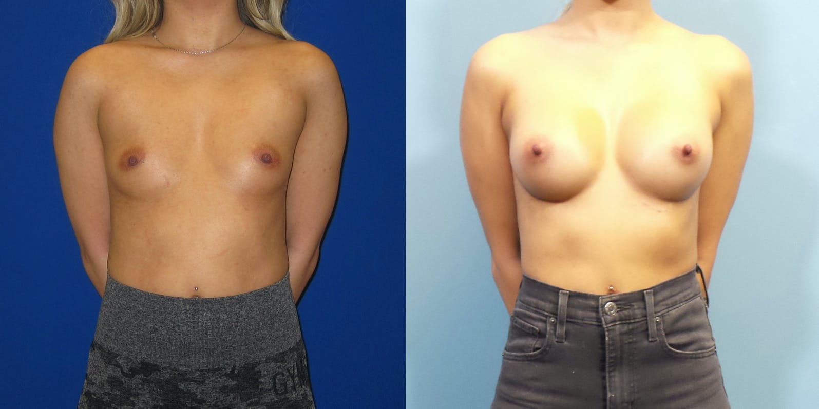 Breast Augmentation Before & After Gallery - Patient 147948 - Image 1