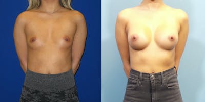 Breast Augmentation Before & After Gallery - Patient 147948 - Image 1