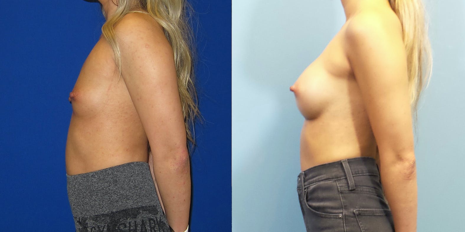 Breast Augmentation Before & After Gallery - Patient 147948 - Image 3