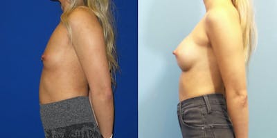 Breast Augmentation Before & After Gallery - Patient 147948 - Image 3