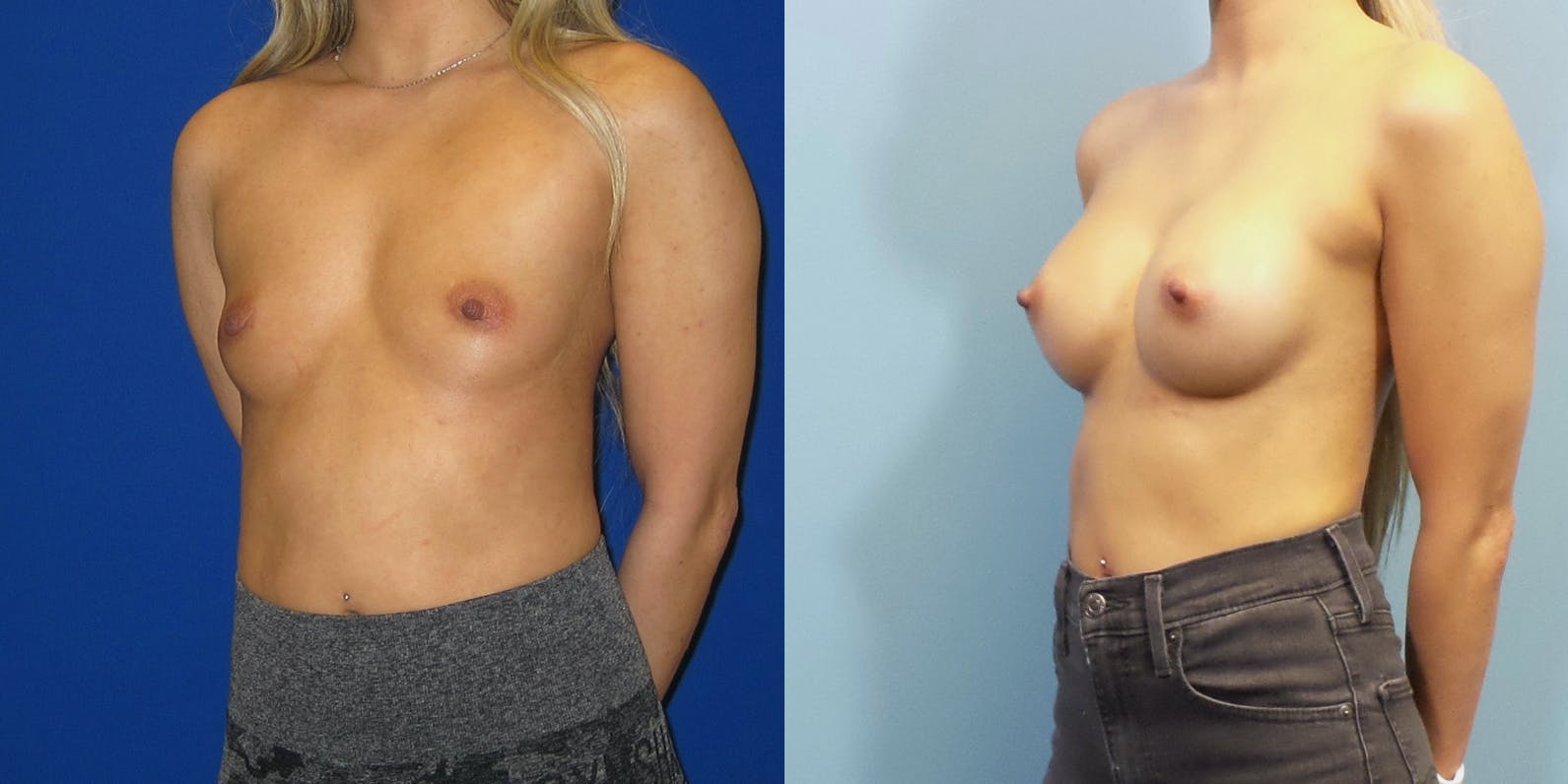 Breast Augmentation Before & After Gallery - Patient 147948 - Image 2