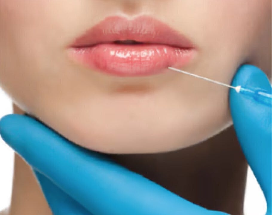 Three Trending Fillers Taking Over the Med Spa Scene