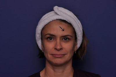 BOTOX Before & After Gallery - Patient 259100 - Image 1