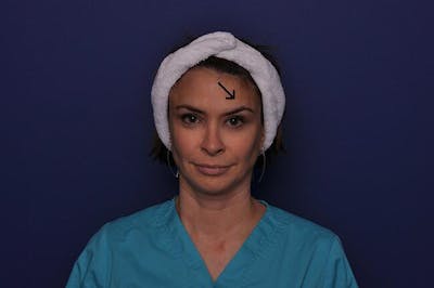 BOTOX Before & After Gallery - Patient 259100 - Image 2