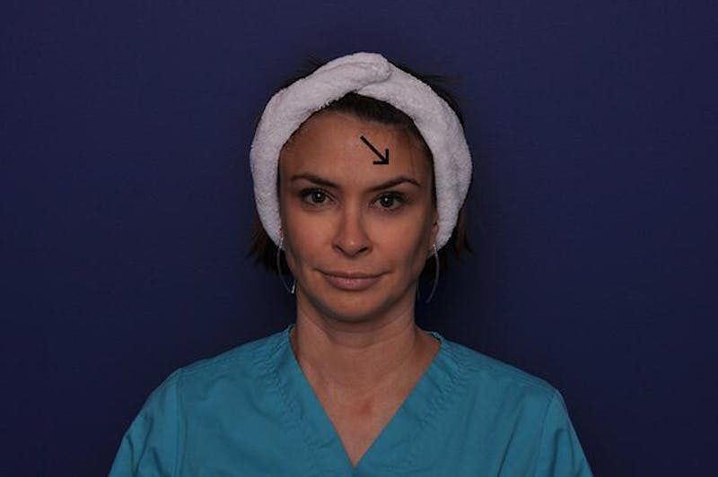 BOTOX Before & After Gallery - Patient 259100 - Image 2