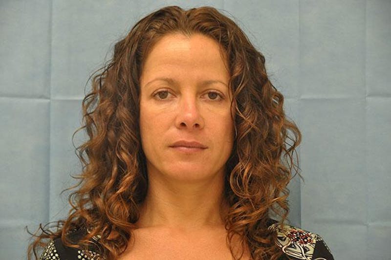 BOTOX Before & After Gallery - Patient 136623 - Image 1