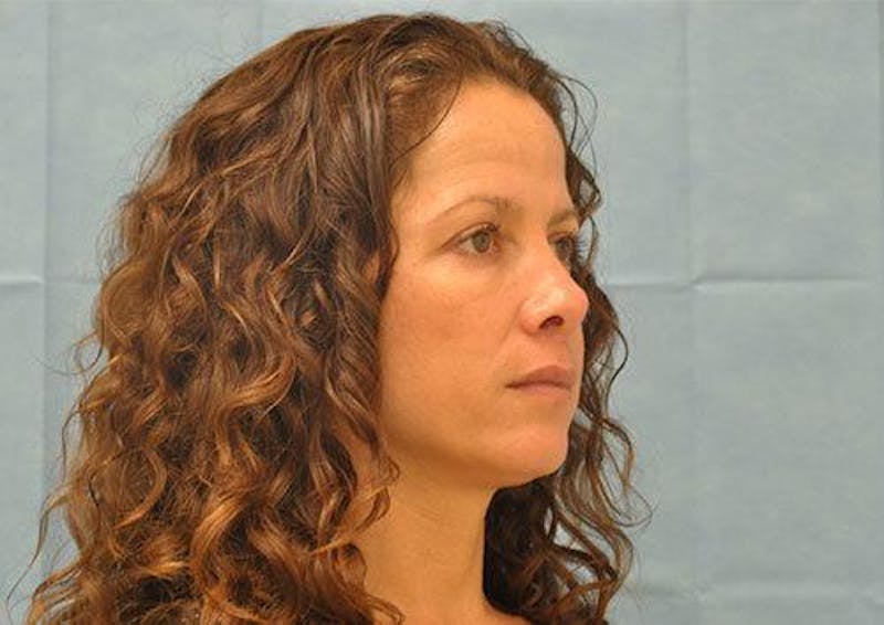BOTOX Before & After Gallery - Patient 136623 - Image 3