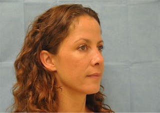 BOTOX Before & After Gallery - Patient 136623 - Image 4