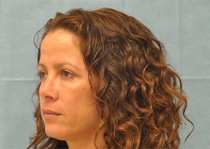 BOTOX Before & After Gallery - Patient 136623 - Image 5