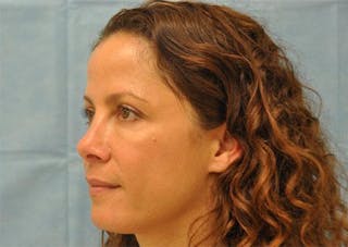 BOTOX Before & After Gallery - Patient 136623 - Image 6