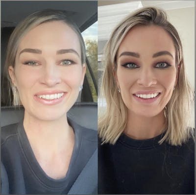 BOTOX for Bell's Palsy Before & After Gallery - Patient 413417 - Image 1