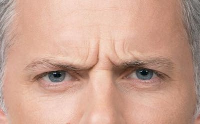 BOTOX for Men Before & After Gallery - Patient 102012 - Image 1