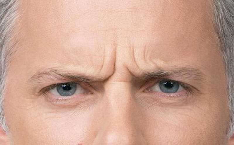 BOTOX for Men Before & After Gallery - Patient 102012 - Image 1
