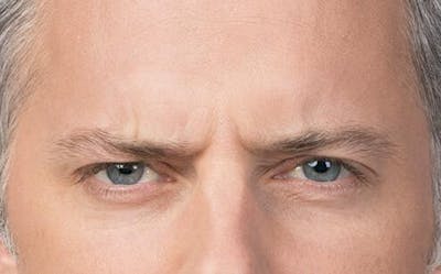 BOTOX for Men Before & After Gallery - Patient 102012 - Image 2
