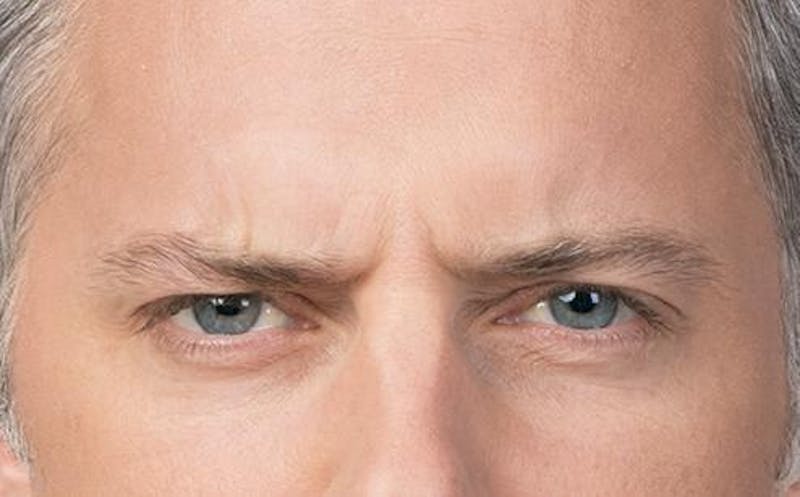 BOTOX for Men Before & After Gallery - Patient 102012 - Image 2